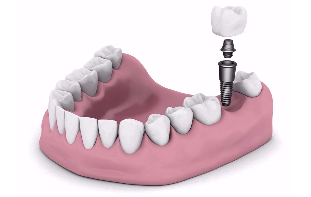 Zahnimplantate 3d-Modell isoliert auf weißem Hintergrund