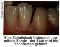 Eine Zahnfleisch-Untersuchung mittels Sonde - der Stab wird ins Zahnfleisch geführt