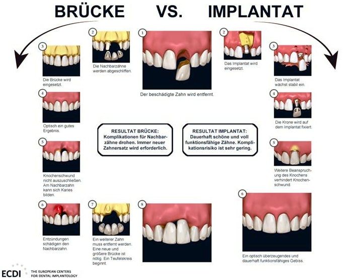 Brücke oder Implantat