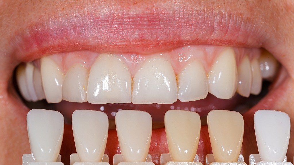 Veneers Farbbestimmung