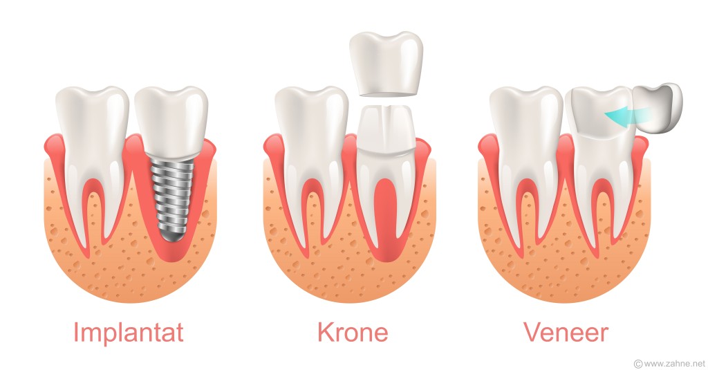 Vergleich Veneer, Krone, Implantat